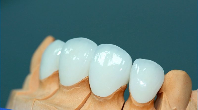 Що обрати зубні вініри або коронки та де пройти процедуру